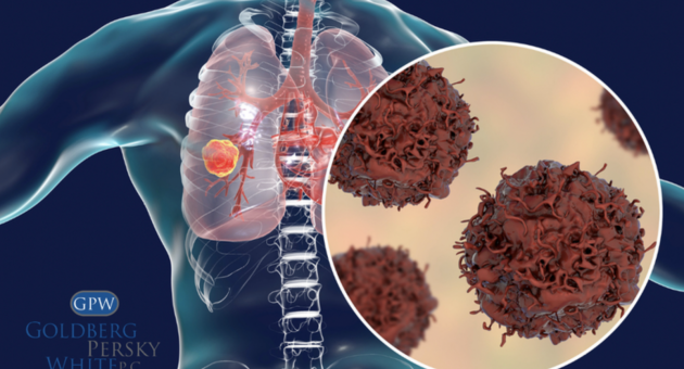 Signs and Symptoms of Mesothelioma