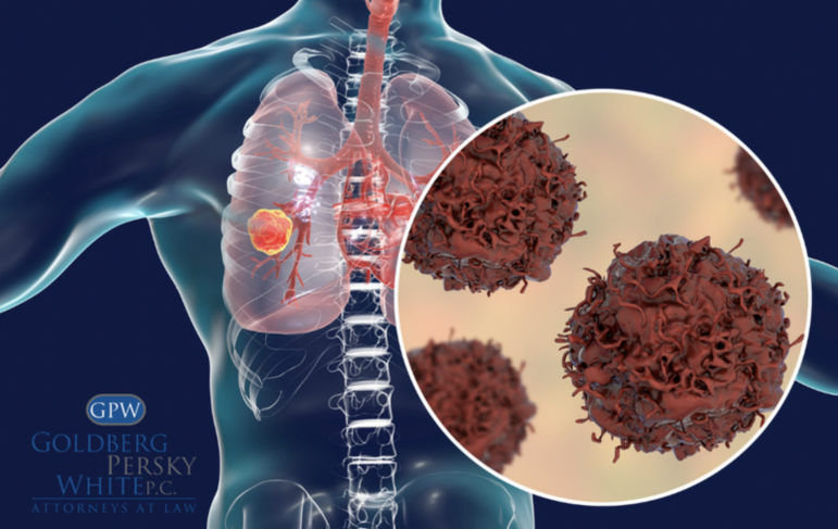 Signs and Symptoms of Mesothelioma
