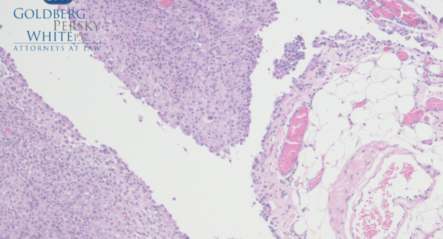 HOW IS MESOTHELIOMA DIAGNOSED?