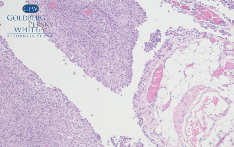 HOW IS MESOTHELIOMA DIAGNOSED?