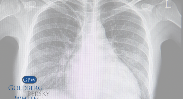 Pleural Mesothelioma