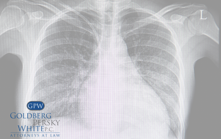 Pleural Mesothelioma
