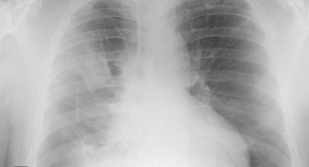 Pleural Mesothelioma: A Review
