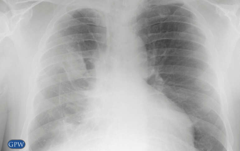 Pleural Mesothelioma: A Review