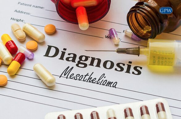 Common Questions About Mesothelioma